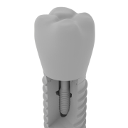 Implant zęba - 2