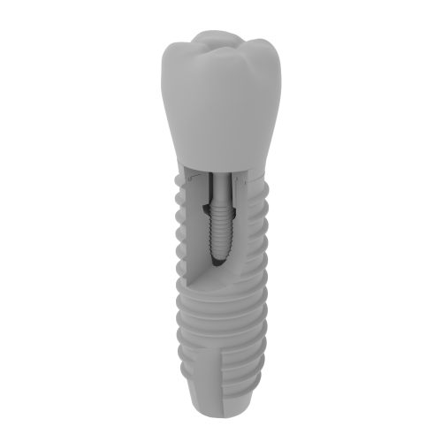 Implant zęba - 1